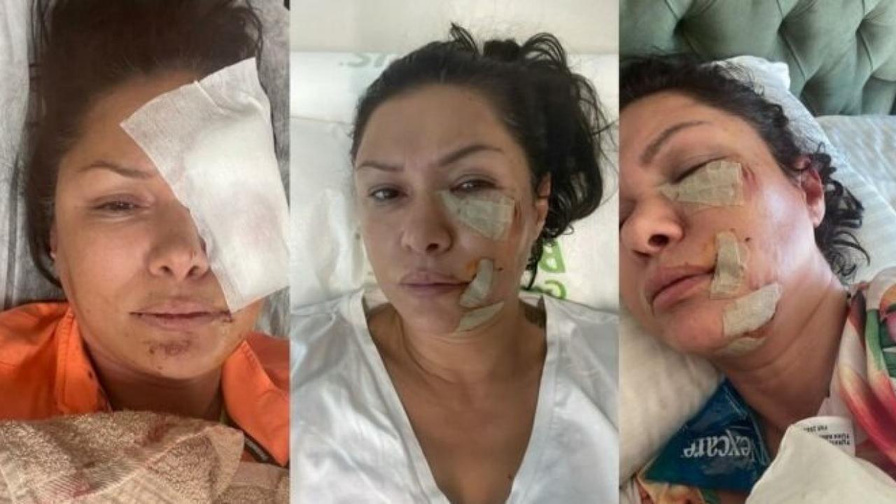 Şarkıcı Tuğba Altıntop köpek saldırısına uğradı, yüzüne dikiş atıldı